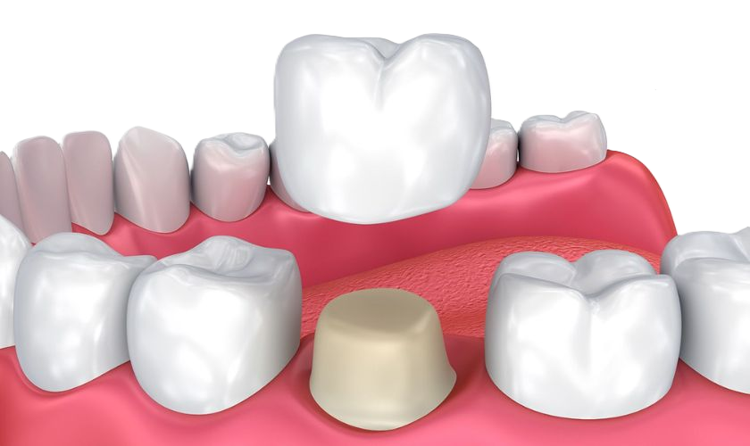 3D Dental Crown