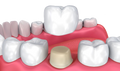 3D Dental Crown