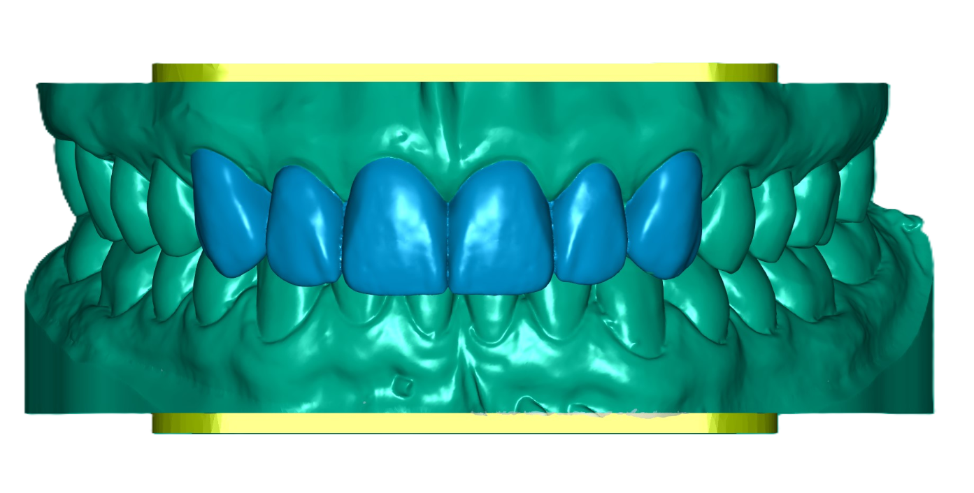 3D Printed Waxed Up Study Model (Price per Tooth)