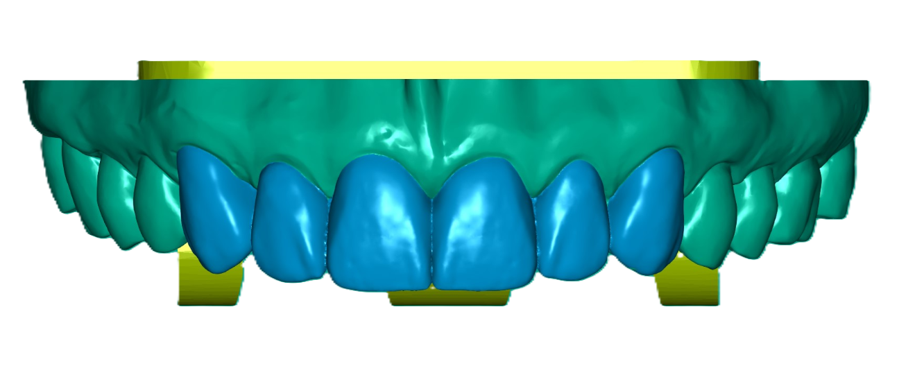 3D Printed Waxed Up Study Model (Price per Tooth)