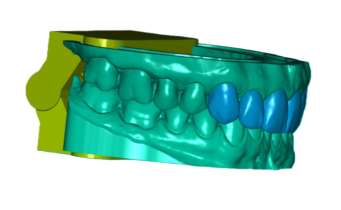 3D Printed Waxed Up Study Model (Price per Tooth)