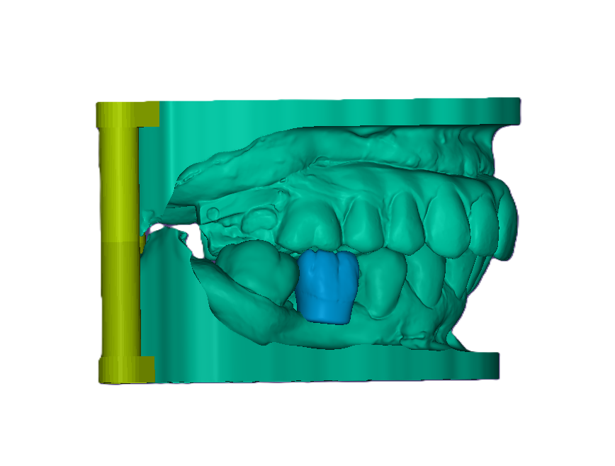3D Printed Waxed Up Study Model (Price includes 1 Tooth)-42mm