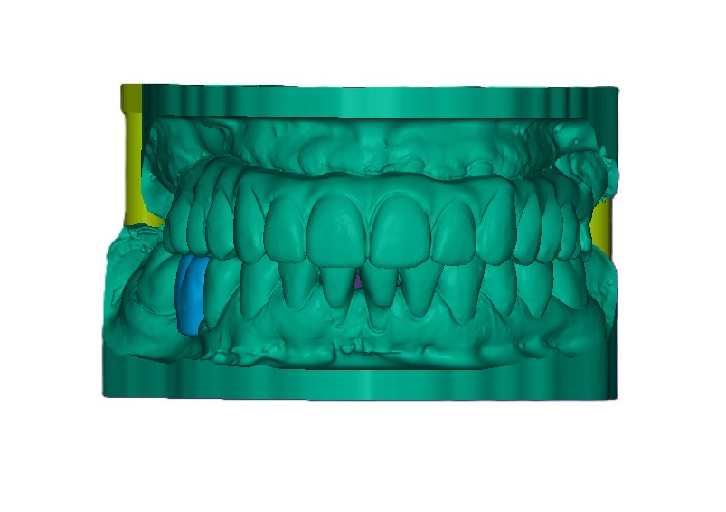 3D Printed Waxed Up Study Model (Price includes 1 Tooth)-42mm