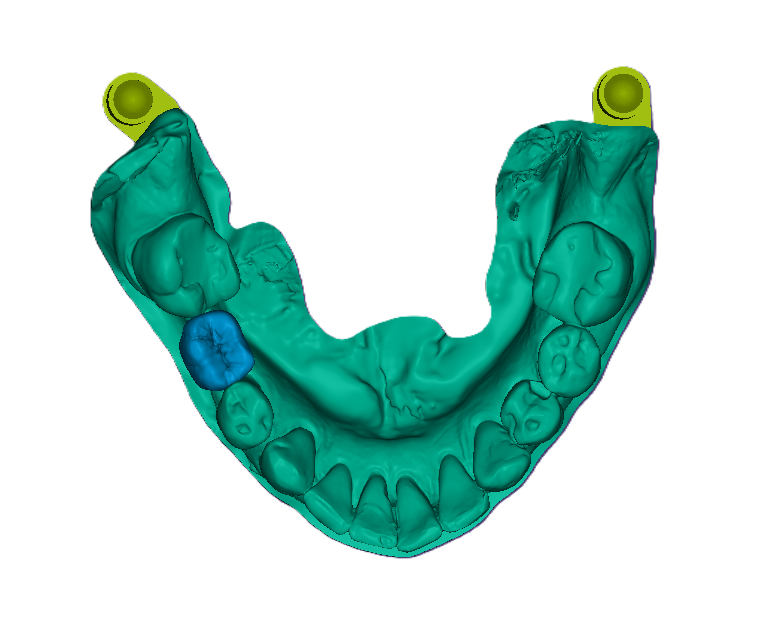 3D Printed Waxed Up Study Model (Price includes 1 Tooth)-42mm