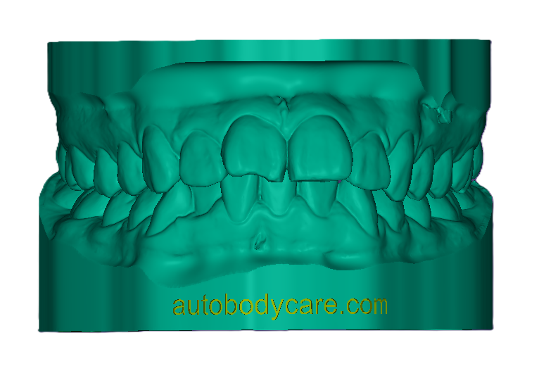 3D Study Model W/ Attachment (42mm)