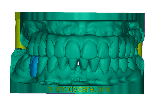 3D Printed Mockup Model (Price includes 1 Tooth)-42mm
