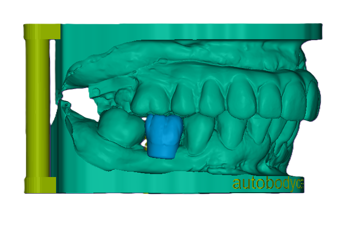 3D Printed Mockup Model (Price includes 1 Tooth)-42mm