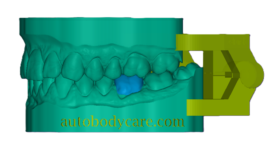 3D Dental Crown