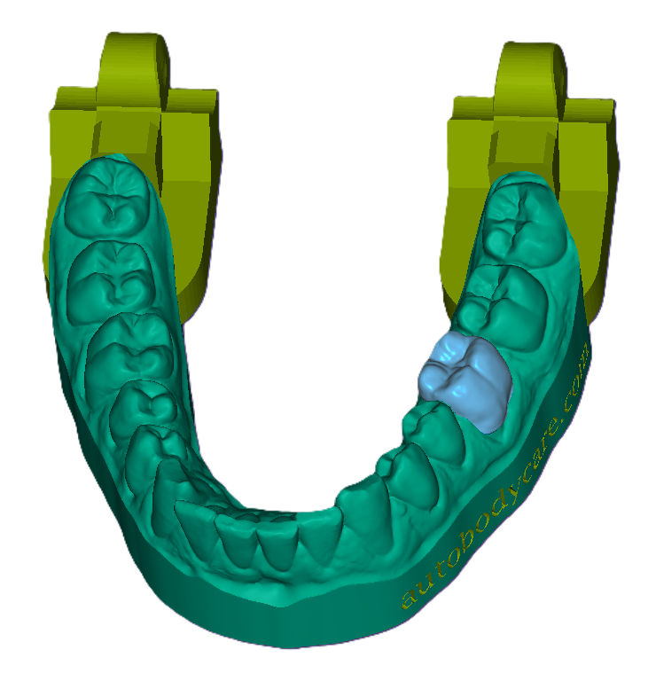 3D Dental Crown
