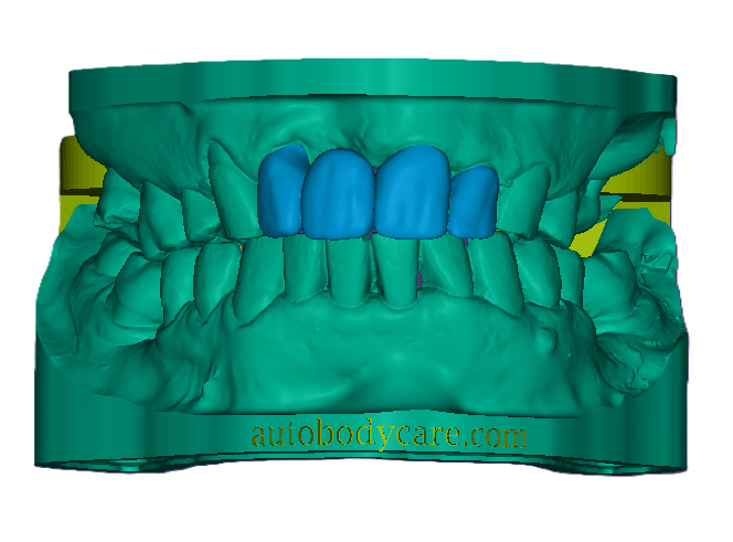 3D Dental Bridge and Mockup Model