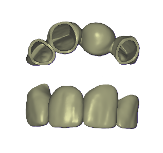 3D Dental Bridge and Mockup Model