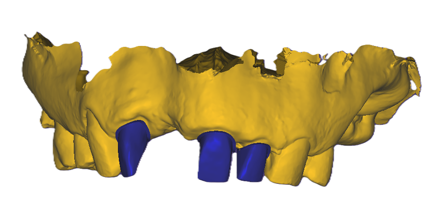 3D Dental Bridge and Mockup Model