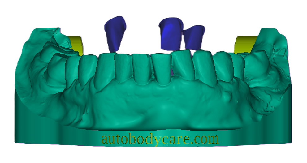 3D Dental Bridge and Mockup Model