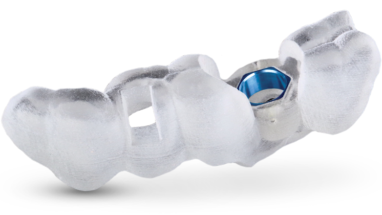 3D Implant Surgical Guide